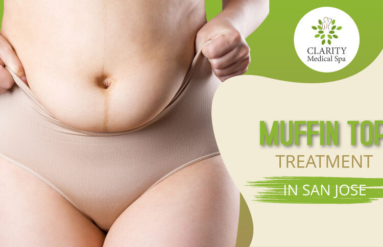 muffin top treatment in san jose