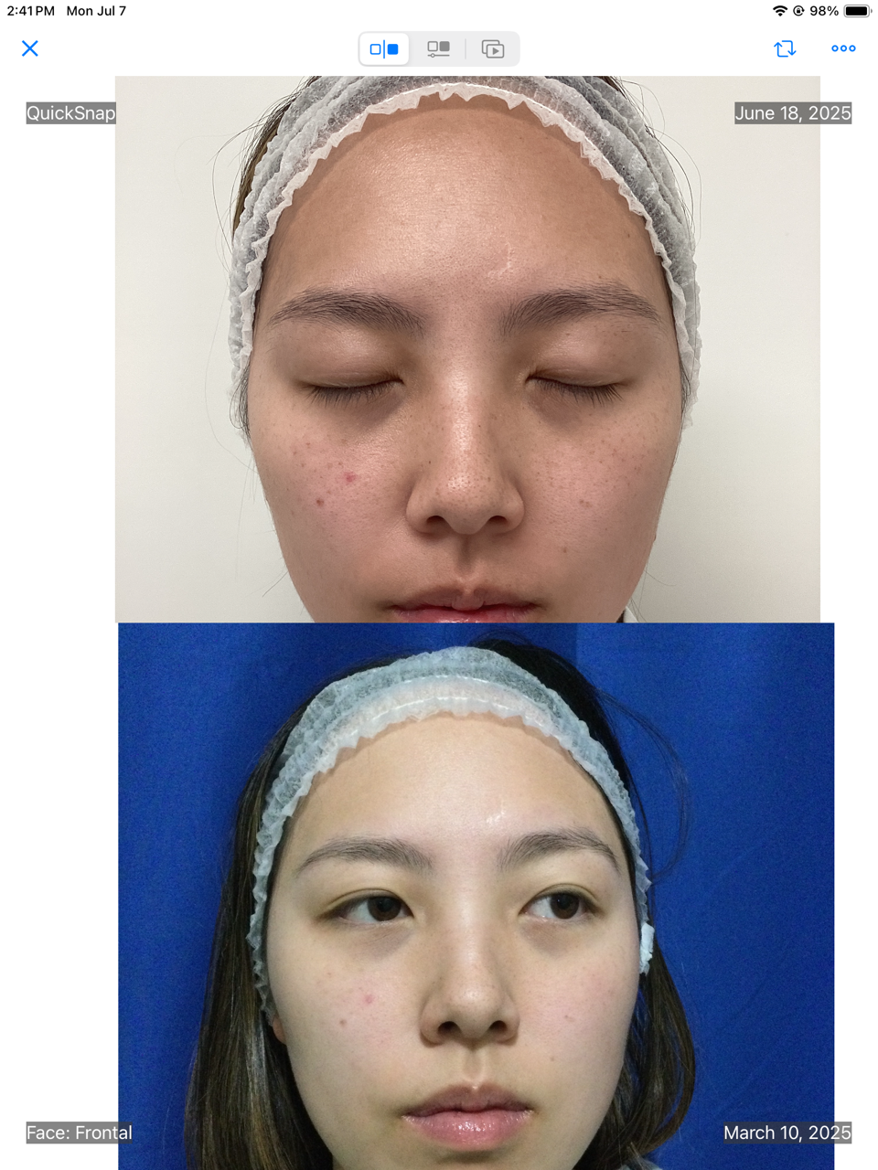 IPL before after