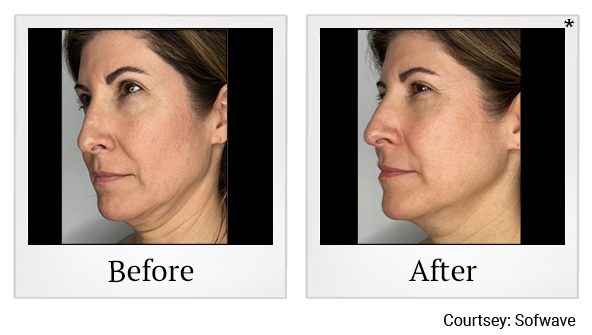 poloroid frame sidebyside sofwave7