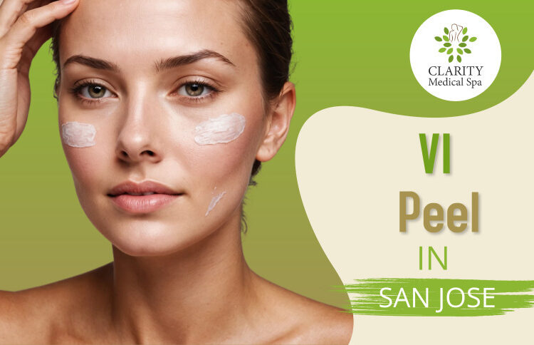 vi peel in sanjose