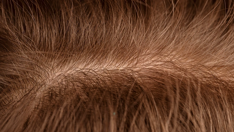 Hair Restoration in San Jose