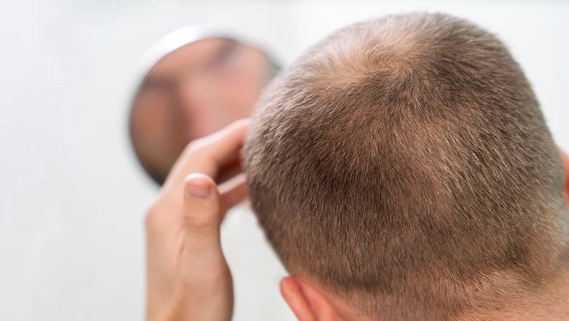 Hair Restoration 1