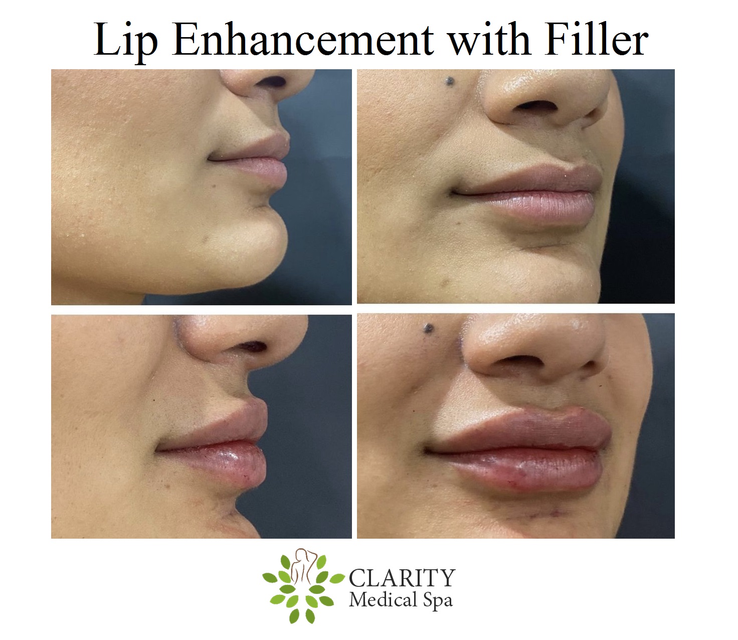 Lip filler