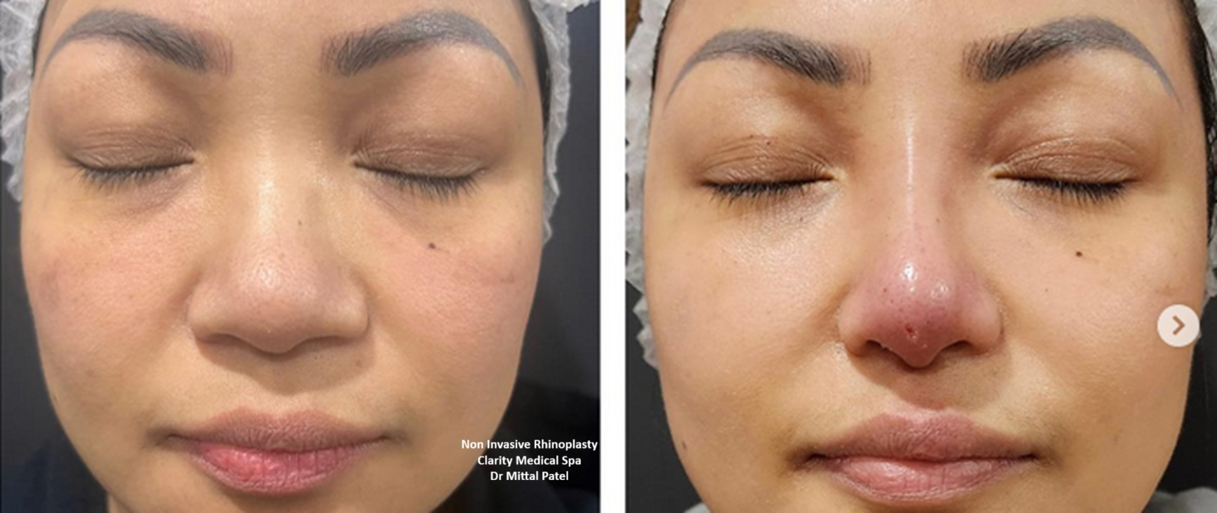 rhinoplasty 1