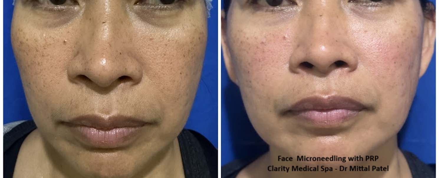 microneedling 3