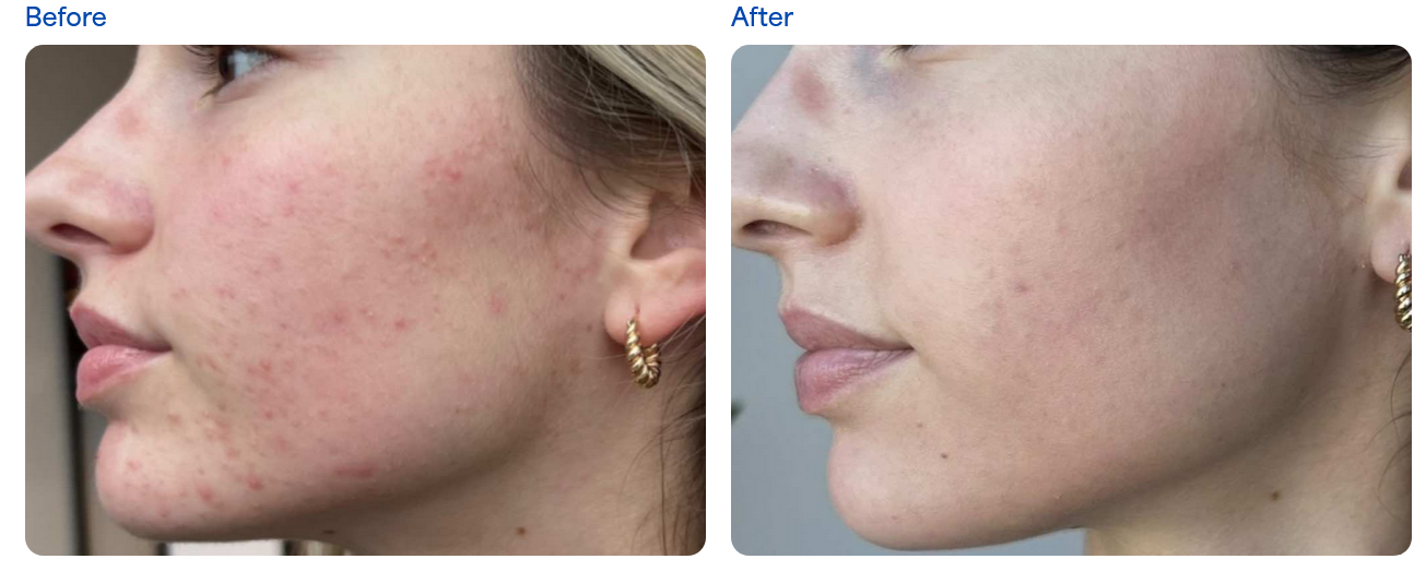 microneedling before after